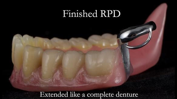 Finlay's Newsletter 59 Ultra hard partial dentures made for Gill