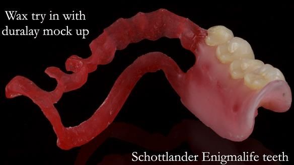 Finlay's Newsletter 61 provision of a lower unilateral free end saddle metal based partial denture for Joyce