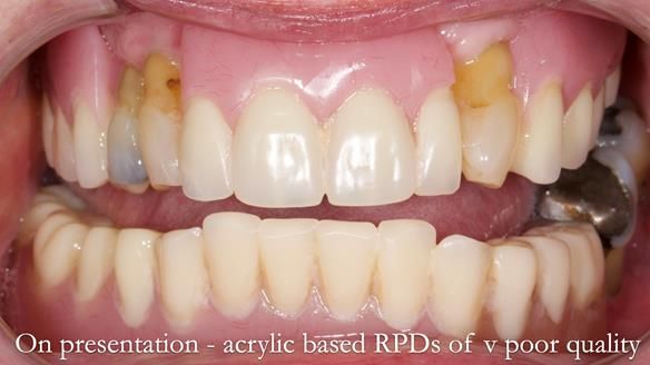 Finlay's Newsletter 59 Ultra hard partial dentures made for Gill