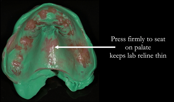 Figure 52 Laboratory reline in light bodied silicone impression material. This is placed firmly in the mouth seating fully in the palate and border moulded as per a definitive impression