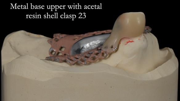 Newsletter 55 Provision of metal based partial dentures for Zephyrine with a repaired cleft lip and palate