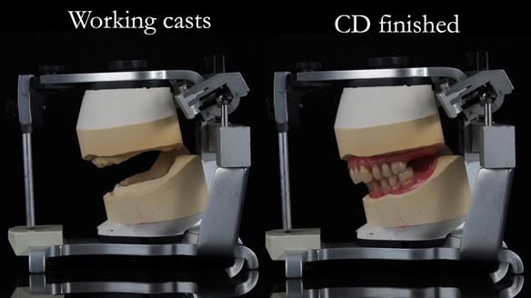 Finlay's Newsletter 62 provision of extractions and metal based complete dentures for Rafique