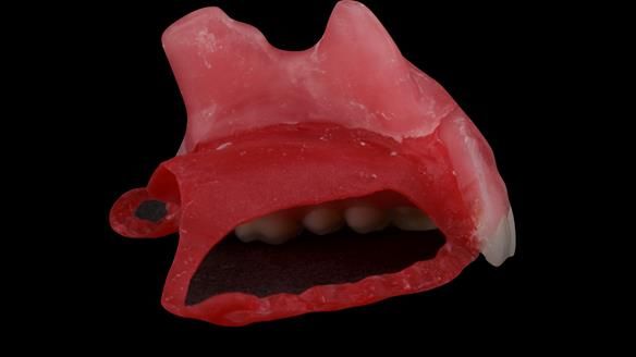 Upper metal base partial denture/occlusal stabilisation splint/obturator - full protocol