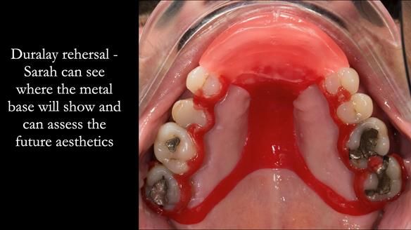 Finlay's Newsletter 63 Case study provision of metal based Scandinavian RPD - functional 10 years on