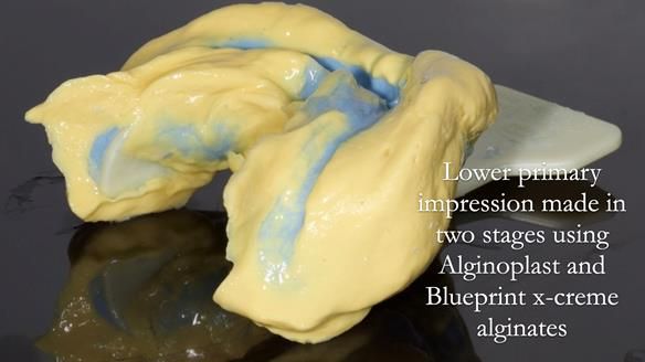 Newsletter 57 showcases the making and fitting process of implant-supported complete dentures for Alisdair