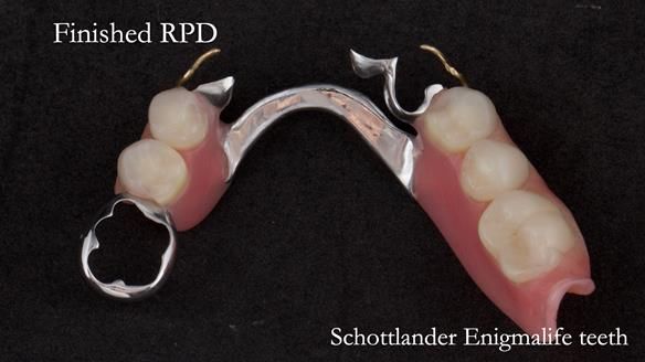 Eileen's transformation with upper and lower RPDs of Scandinavian hygienic design FULL PROTOCOL