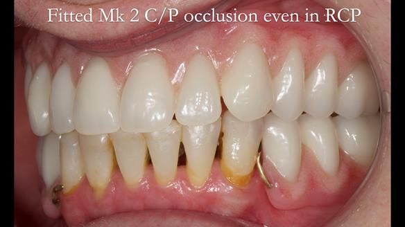 Newsletter 52 Managing Jo’s failing dentition with extractions and Mk 1/Mk 2 complete upper dentures and lower partial dentures FULL PROTOCOL