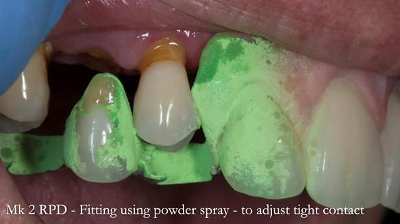 Finlay's Newsletter 63 Case study provision of metal based Scandinavian RPD - functional 10 years on