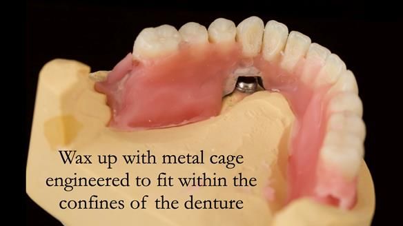 Managing poor implant positioning with complete dentures and Locator attachments - full protocol Newsletter 41