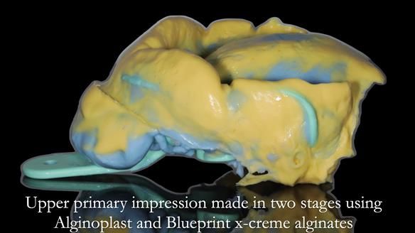 Finlay's Newsletter 58 Gasket upper partial denture for Zoe