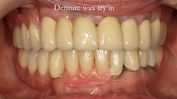 Newsletter 76: Jackie’s case – Telescopic overdenture & precision RPD (the tricky truth!)