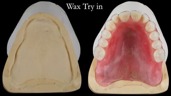 Replacing Madeline’s Complete denture FULL PROTOCOL