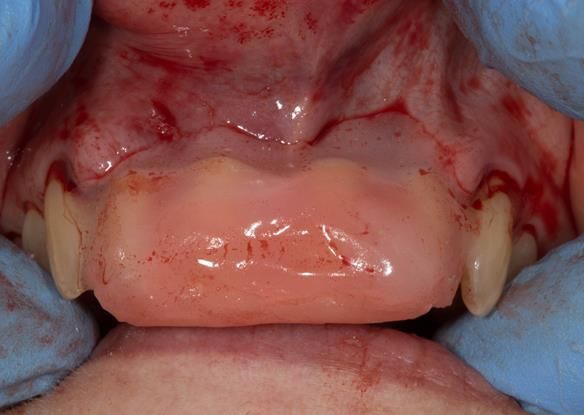  Figure 38 Visco-gel temporary soft reline moulded in the mouth. The denture was seated fully with pressure on the palate