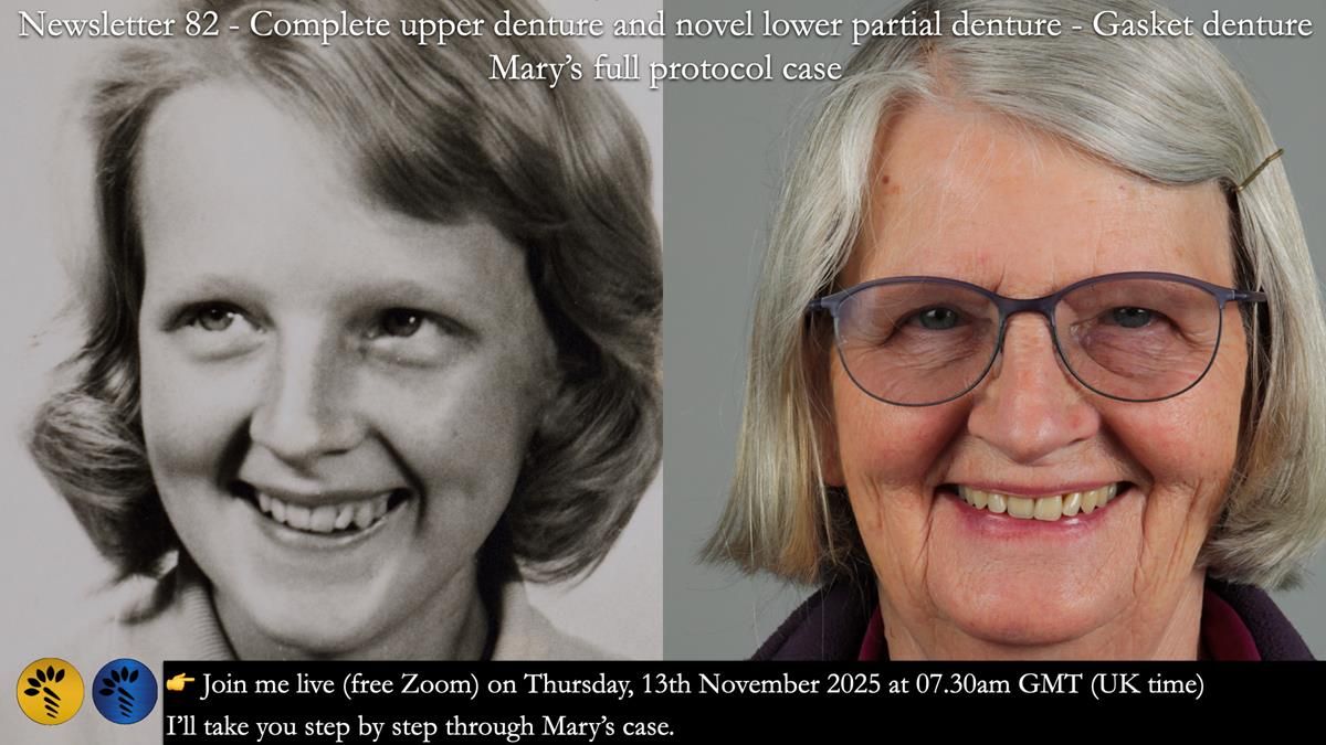 Newsletter 82 Mary - A complete upper and a one-tooth gasket denture