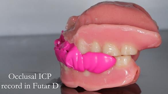 Finlay's Newsletter 62 provision of extractions and metal based complete dentures for Rafique