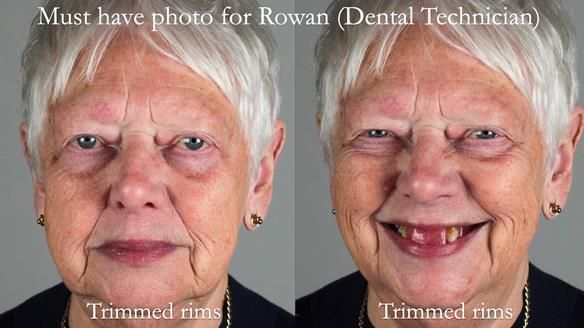 Finlay's Newsletter 59 Ultra hard partial dentures made for Gill