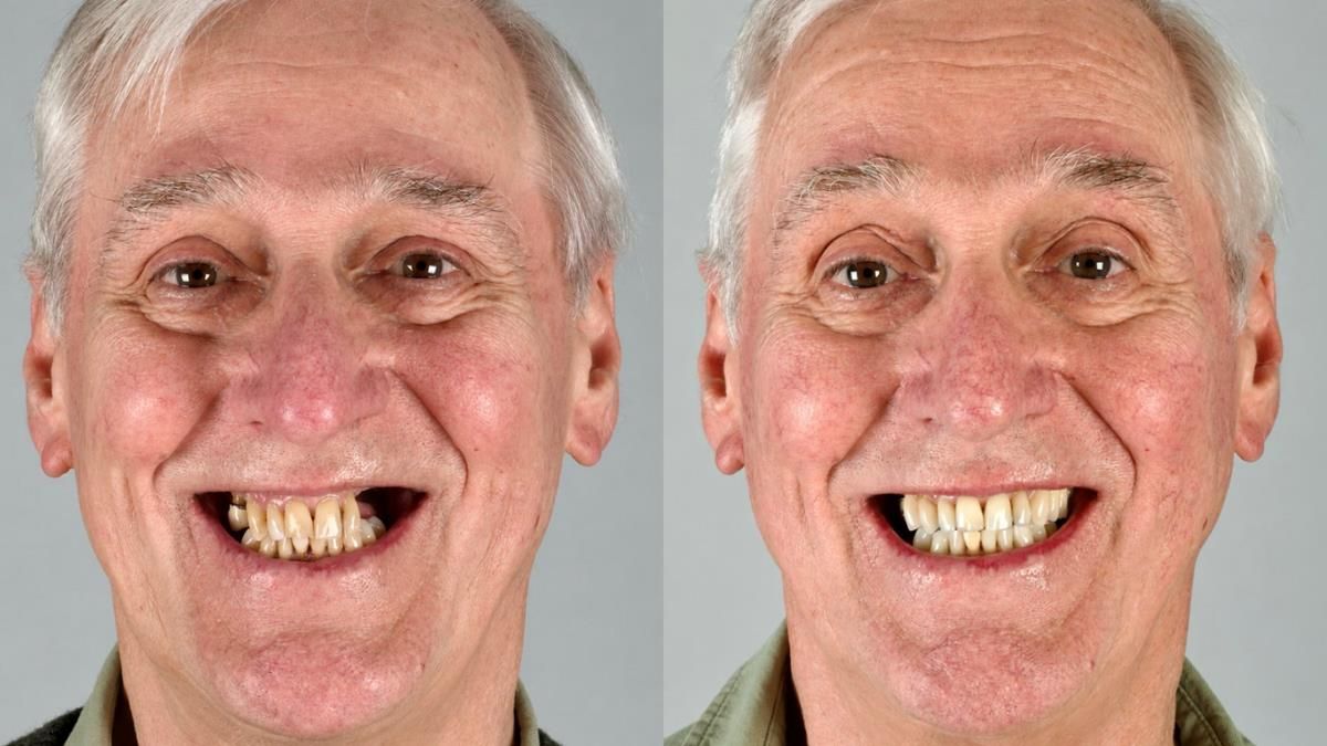 Newsletter 89 – Simon: A Challenging Kennedy Class II Division 1 Upper CoCr Partial Denture with a High Smile Line