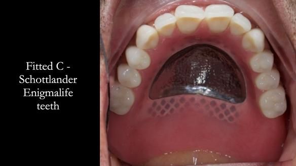 Managing poor implant positioning with complete dentures and Locator attachments - full protocol Newsletter 41