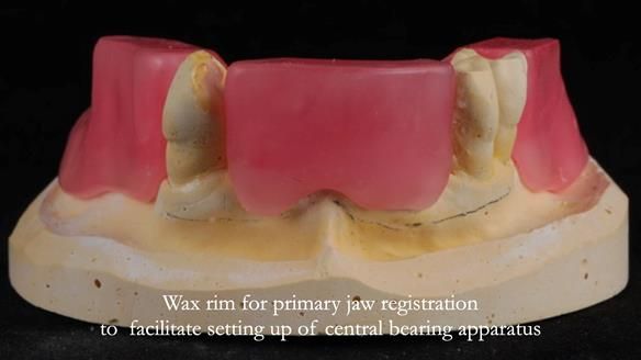 Finlay's Newsletter 59 Ultra hard partial dentures made for Gill