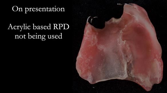 Newsletter 55 Provision of metal based partial dentures for Zephyrine with a repaired cleft lip and palate