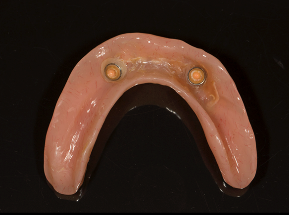 Figure 5 Pre-treatment lower implant supported complete denture. Under-extended in retromolar area and overextended labially, indicating a lack of border moulding during impression taking.