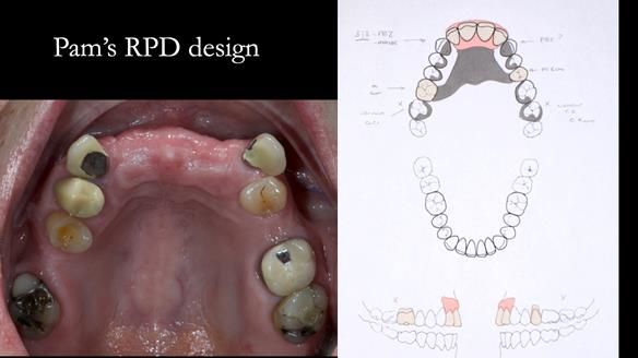 Newsletter 81 - Pam’s Story — how a partial denture changed her life (+ live walkthrough this Thursday)