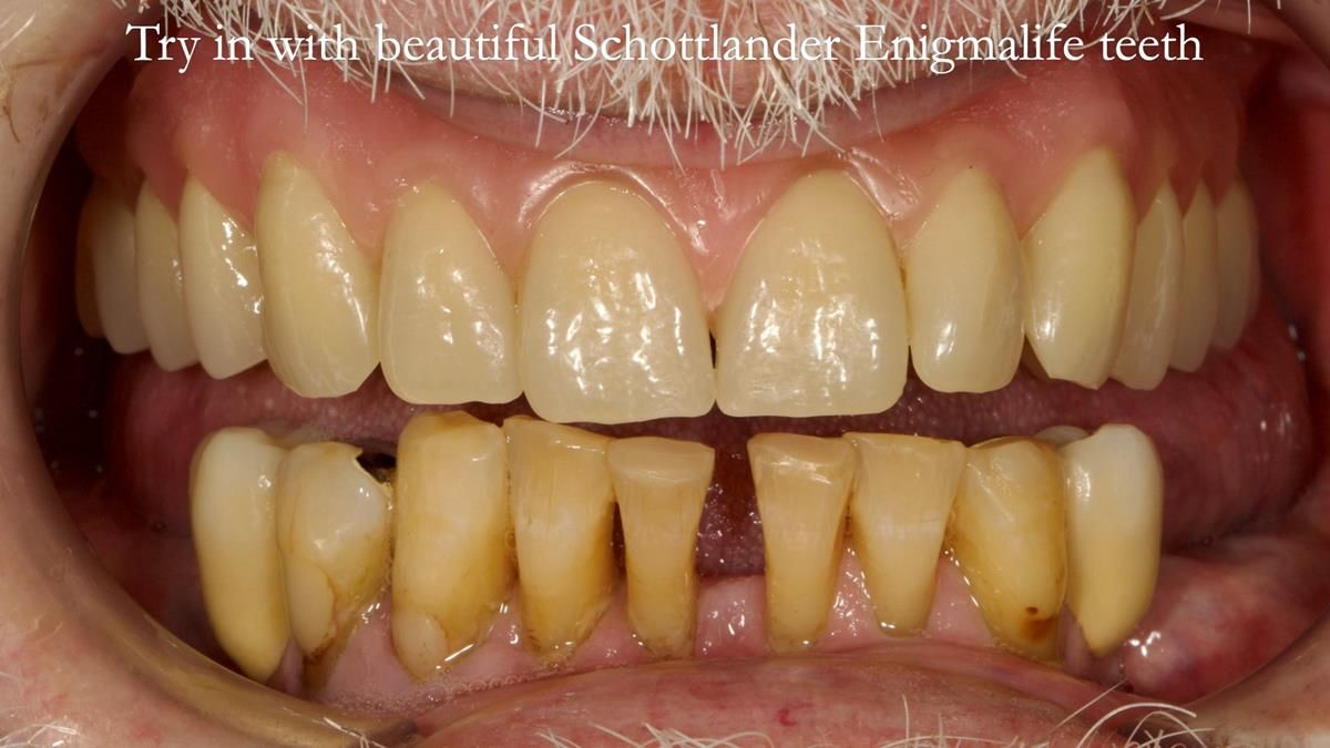 Newsletter 87 – Father Peter: A Partial Denture that needed Minor Miracle