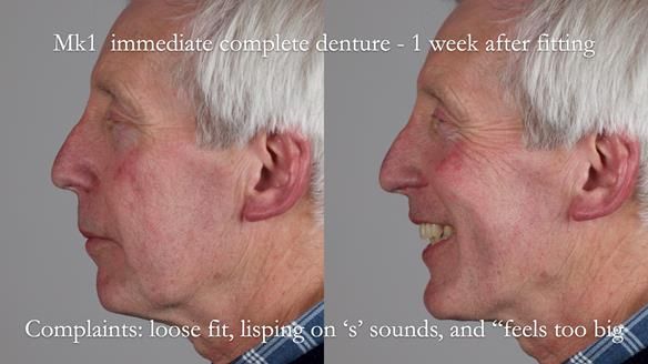 Newsletter 77: Jeremy’s case – immediate complete upper denture