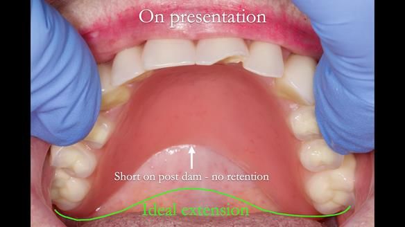 Replacing Madeline’s Complete denture FULL PROTOCOL