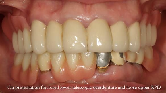 Newsletter 76: Jackie’s case – Telescopic overdenture & precision RPD (the tricky truth!)