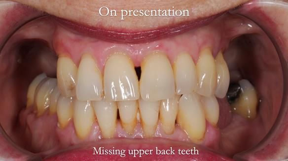 Newsletter 56 showing the making and fitting of a bilateral free end saddle upper removable partial denture (RPD) for patient with pemphigus