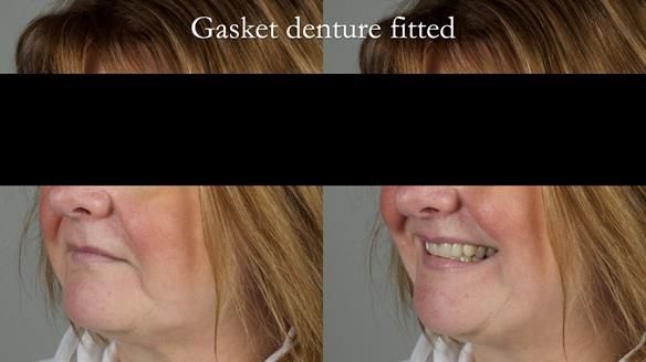 Finlay's Newsletter 58 Gasket upper partial denture for Zoe