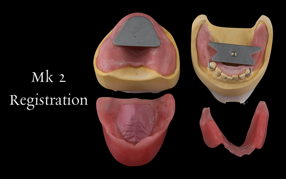Figure 82 Visit 3 for Mk 2 fabrication. Registration visit with central bearing apparatus for CR recording and wax rims for tooth position and OVD recording