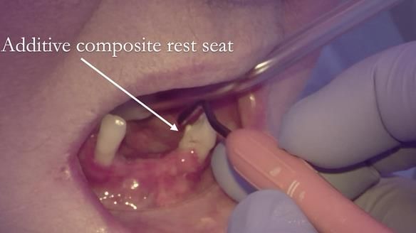Finlay's Case Study Newsletter 40 - Immediate Mk 1 RPD to Definitive Mk 2 RPD - full protocol