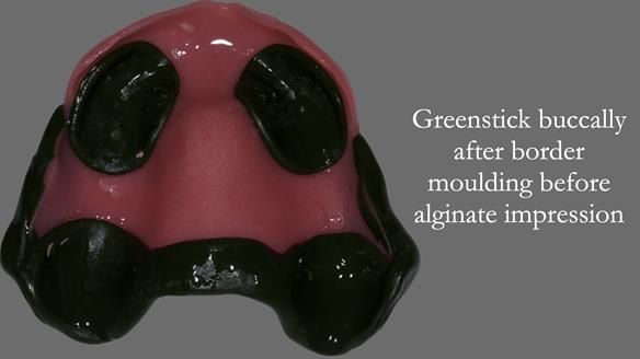 Newsletter 50 Special edition Complete Dentures FULL PROTOCOL