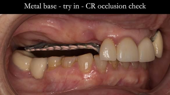 Newsletter 51 Managing Anne’s failing dentition with distal extension base RPD/Splint FULL PROTOCOL
