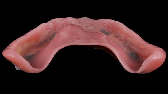 Newsletter 52 Managing Jo’s failing dentition with extractions and Mk 1/Mk 2 complete upper dentures and lower partial dentures FULL PROTOCOL