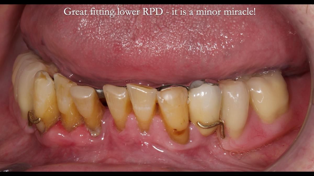 Newsletter 87 – Father Peter: A Partial Denture that needed Minor Miracle