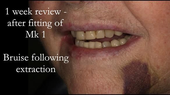 Finlay's Case Study Newsletter 40 - Immediate Mk 1 RPD to Definitive Mk 2 RPD - full protocol