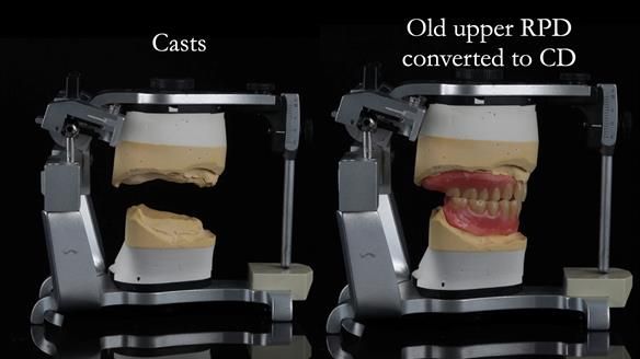 Finlay's Newsletter 62 provision of extractions and metal based complete dentures for Rafique
