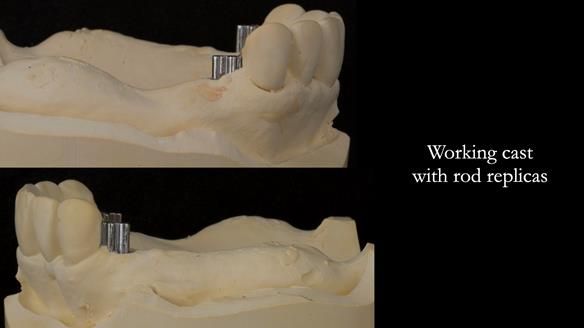 Newsletter 76: Jackie’s case – Telescopic overdenture & precision RPD (the tricky truth!)