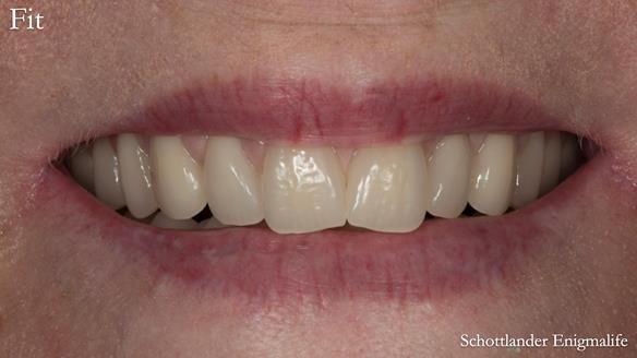 Newsletter 75: Marion’s case - Step-by-step complete denture workflow