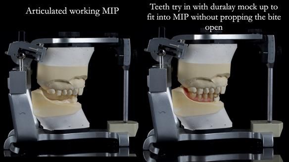 Finlay's Newsletter 61 provision of a lower unilateral free end saddle metal based partial denture for Joyce