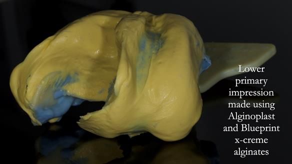 Newsletter 83: Sheila’s Complete Denture Success