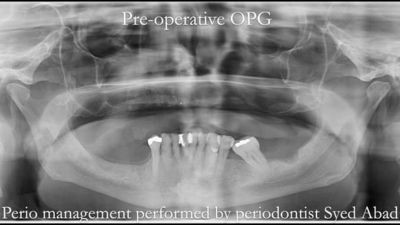 Newsletter 54 case presentation upper complete denture and lower Scandinavian designed hygienic partial denture for David