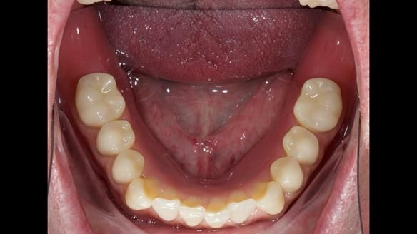 Newsletter 57 showcases the making and fitting process of implant-supported complete dentures for Alisdair