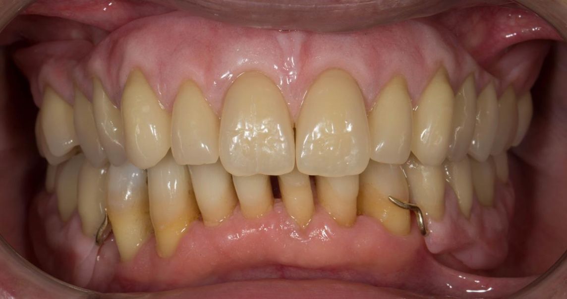 Full Protocol - Transition through extractions and acrylic based immediate dentures to metal based definitive dentures