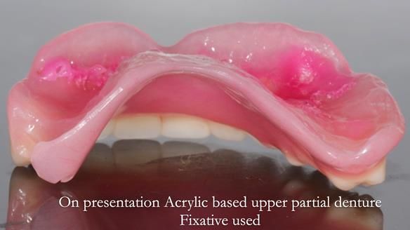 Finlay's Newsletter 58 Gasket upper partial denture for Zoe