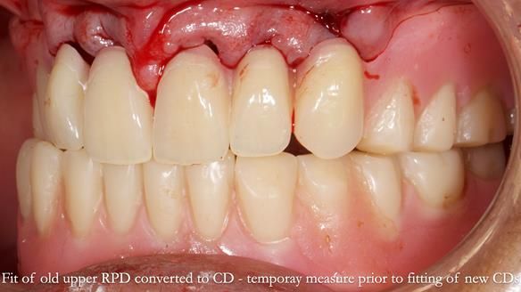 Finlay's Newsletter 62 provision of extractions and metal based complete dentures for Rafique