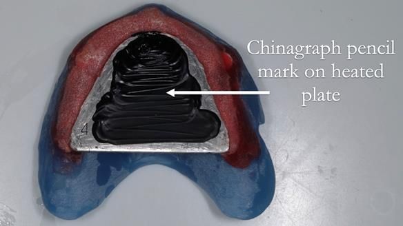 Newsletter 57 showcases the making and fitting process of implant-supported complete dentures for Alisdair